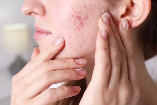 Acne & Acne Scar Treatment