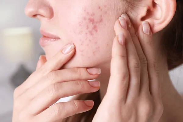 Acne & Acne Scar Treatment