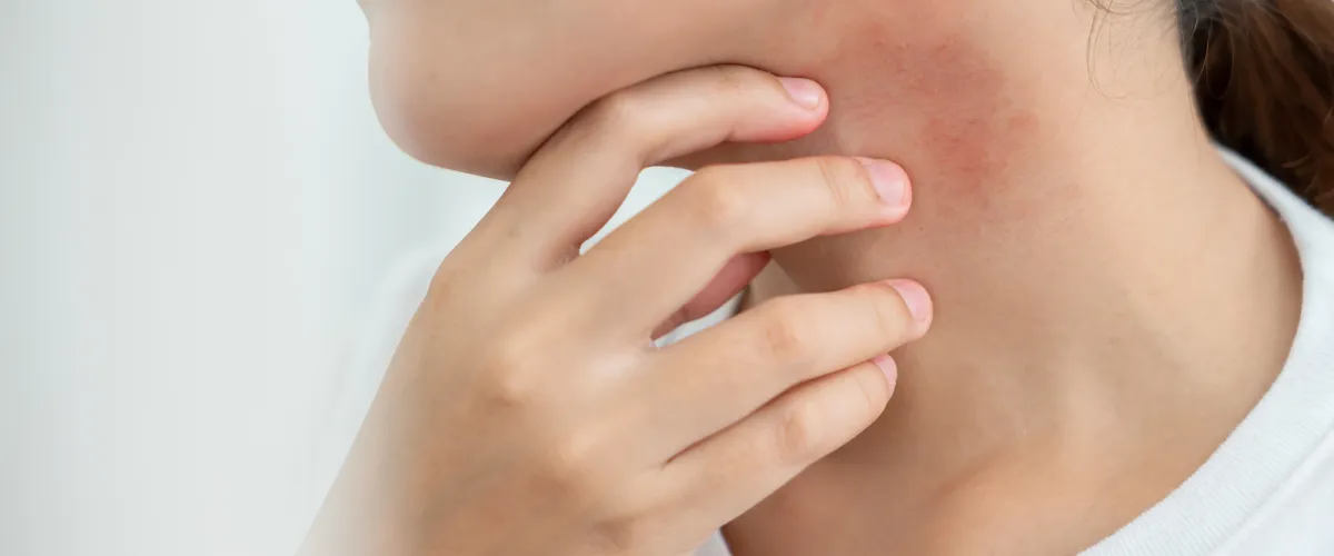 Managing Eczema in the UAE: Heat, Humidity, and Flare Triggers